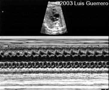 atrial488