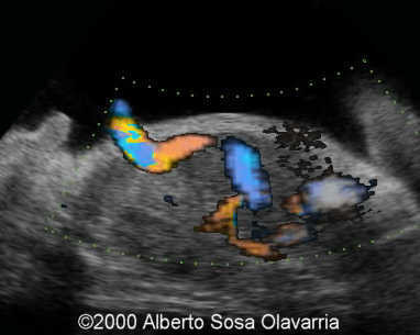 ausencia de ductus venoso