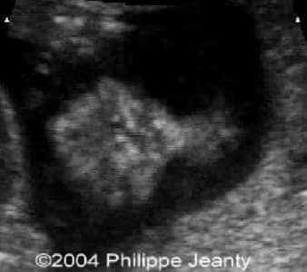 bilcleftlip2