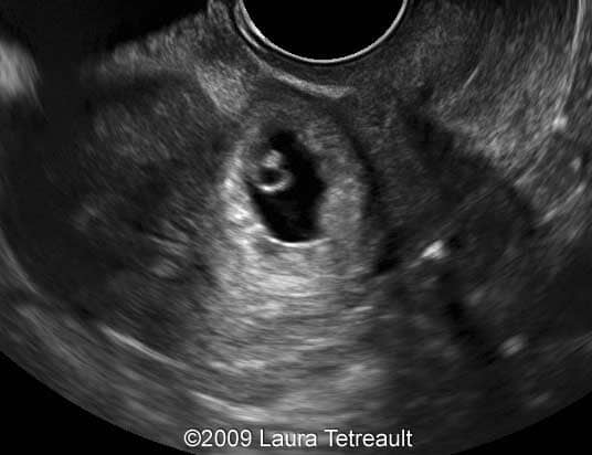 C_section_scar_ectopic