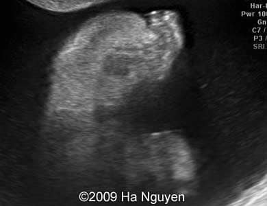 Case_257_11
