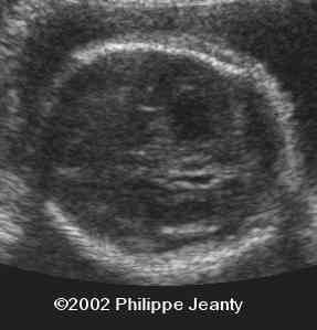 case 76-17