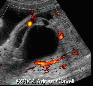 case0014-4
