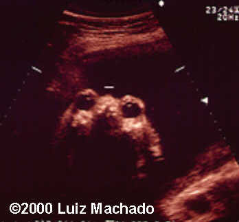 case0032-5