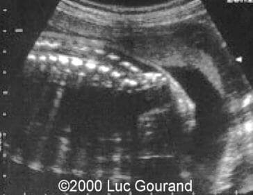 case0035-1