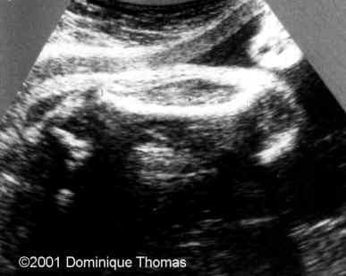 case0044-1