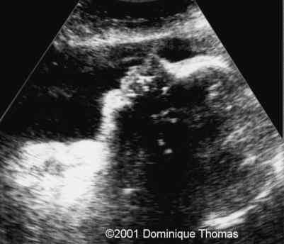 case0044-2