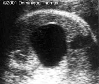 case0044-5
