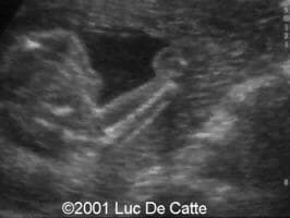 case0045-11