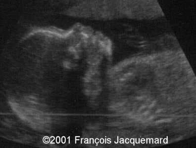 case0046-1