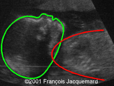case0046-1b