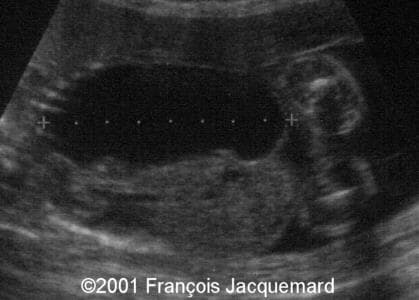 case0046-5