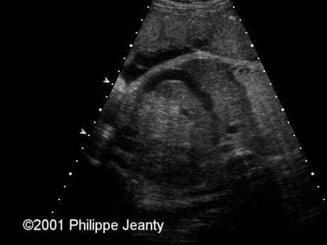 case0054_abdomen