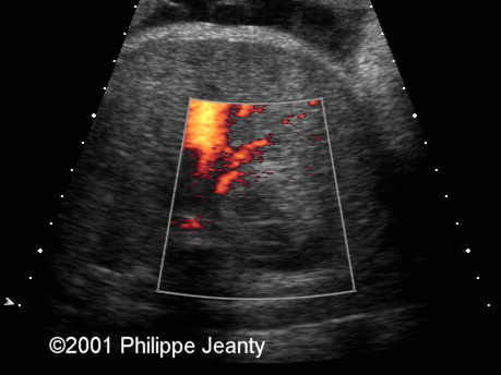 case0054_doppler1