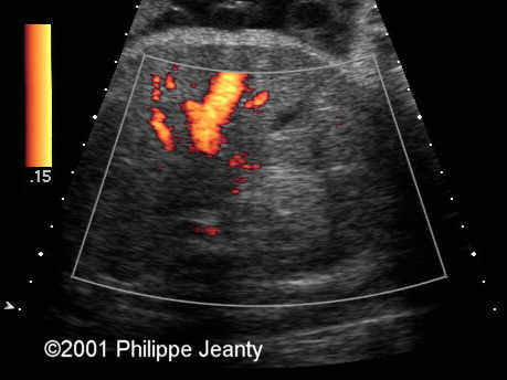 case0054_doppler2
