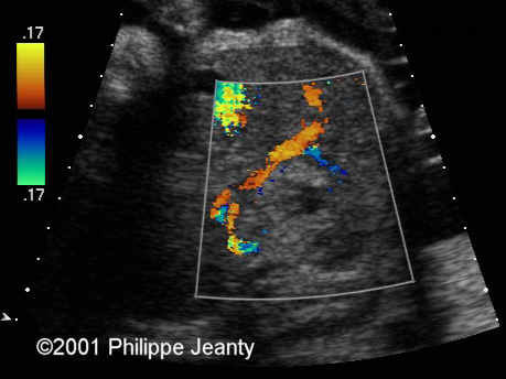 case0054_doppler3