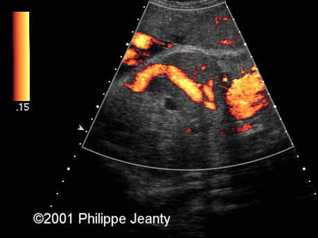 case0054_doppler4