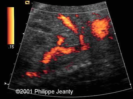 case0054_doppler5