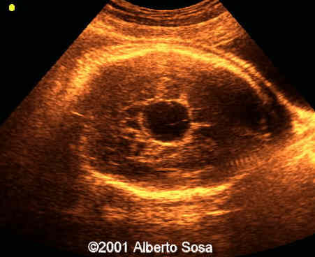 Case0062-11