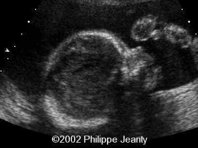case0069-11