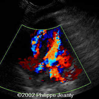 case0074-11