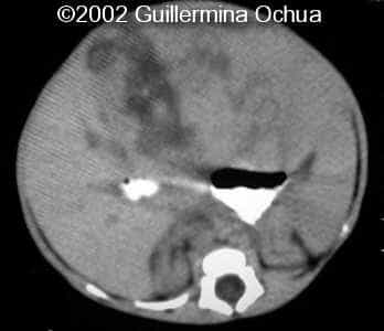 case0078_25