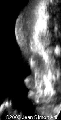 case0093-10