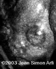 case0093-11