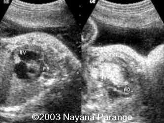 Case0095-05