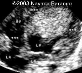Case0095-11