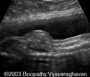 case0097-03