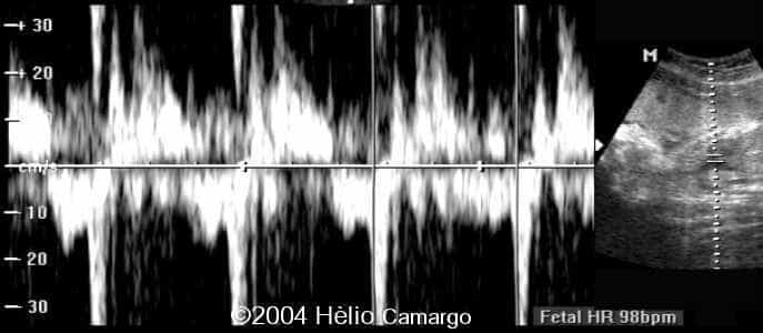 case0130-26