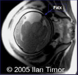 case154_17