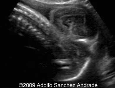 Cephalocoele_2a