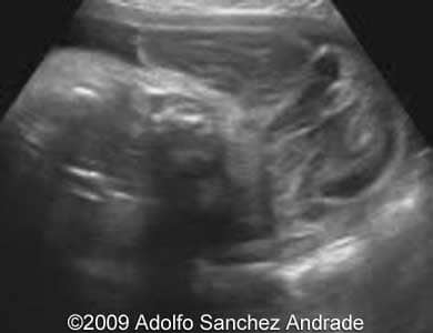 Cephalocoele_3