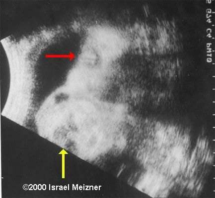 cervical_teratoma_meizner1