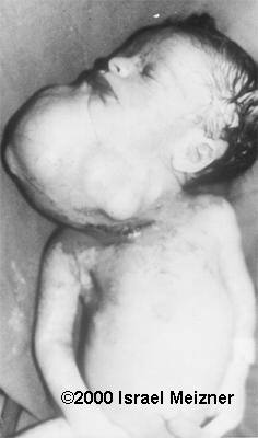 cervical_teratoma_meizner2