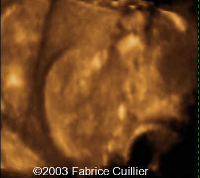CHIARI_11