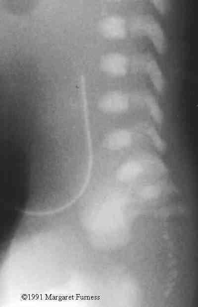 chondro3