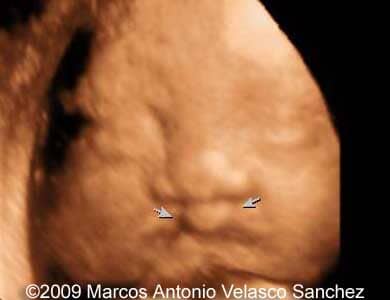 Cleft_10