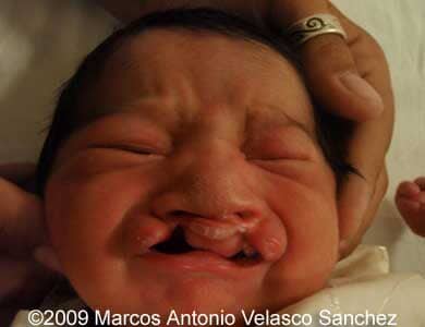 Cleft_11