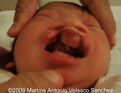 Cleft_12