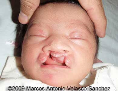 Cleft_13