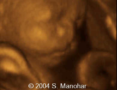 cleftlip4