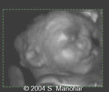 cleftlip5