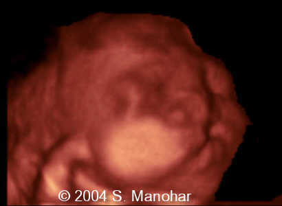 cleftlip6