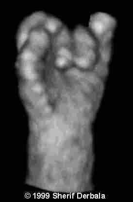 clenched hand