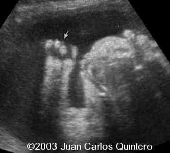 clinodactilia + hernia diaf 31 ss