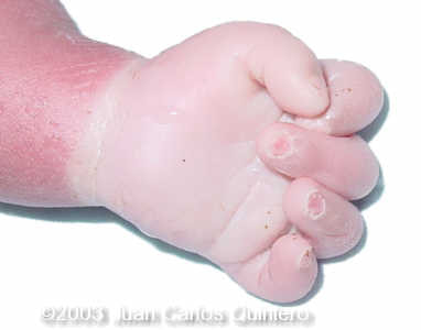 clinodactilia monos 15q