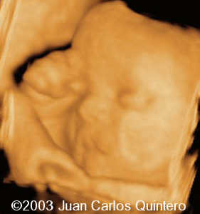 clinodactilia t 18